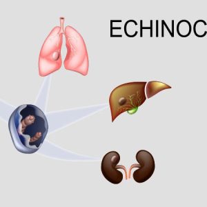 ECHINOCOCCUS DETECTION FOR SCOLICES IN HYDATID CYST FLUID