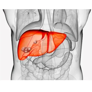 ECHINOCCUS(HYDATID SEROLOGY) IGG