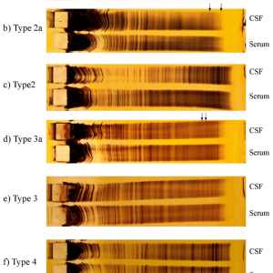 CSF & SERUM PROTEIN ELECTROPHORESIS / OLIGOCLONAL BANDS