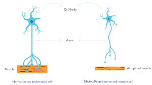 SPINAL MUSCULAR ATROPHY (SMA), MUTATION DETECTION