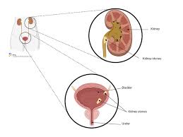 OXALATE, 24-HOUR URINE