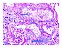 HISTOPATHOLOGY,KIDNEY BIOPSY PANNEL 2