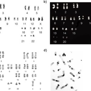 CHROMOSOME(KARYOTYPE) ANALYSIS